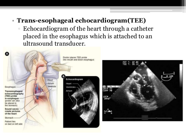 te echocardiogram